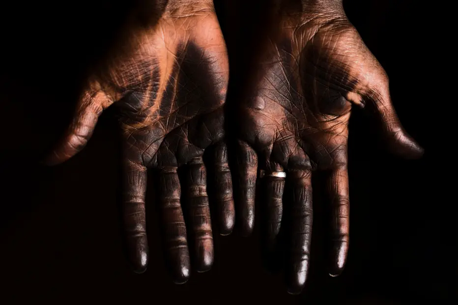 The blackened hands of a woman from Ethiopia