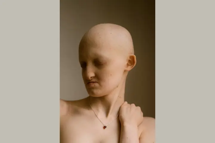 Hannah with Hay-Wells syndrome, a kind of ectodermal dysplasia