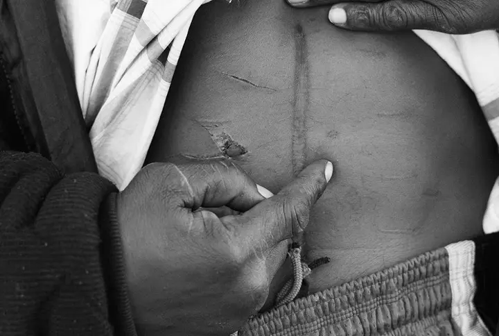 scar on stomach b&w