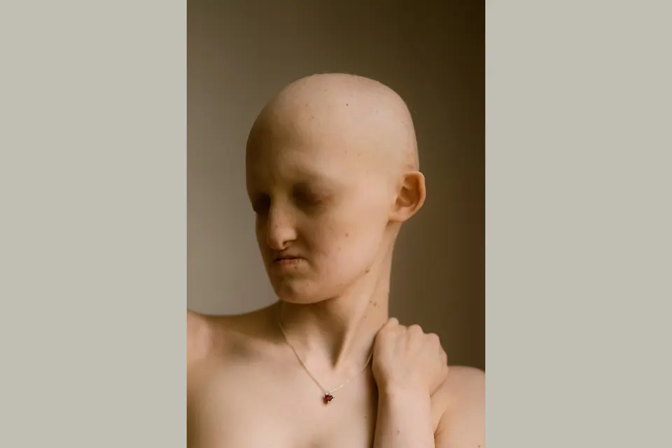 Hannah with Hay-Wells syndrome, a kind of ectodermal dysplasia